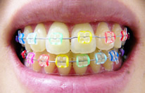 矯正治療の(歯並びを良くする)メリットのイメージ