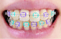 矯正治療の(歯並びを良くする)メリットのイメージ